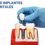 6 Beneficios de los Implantes Dentales