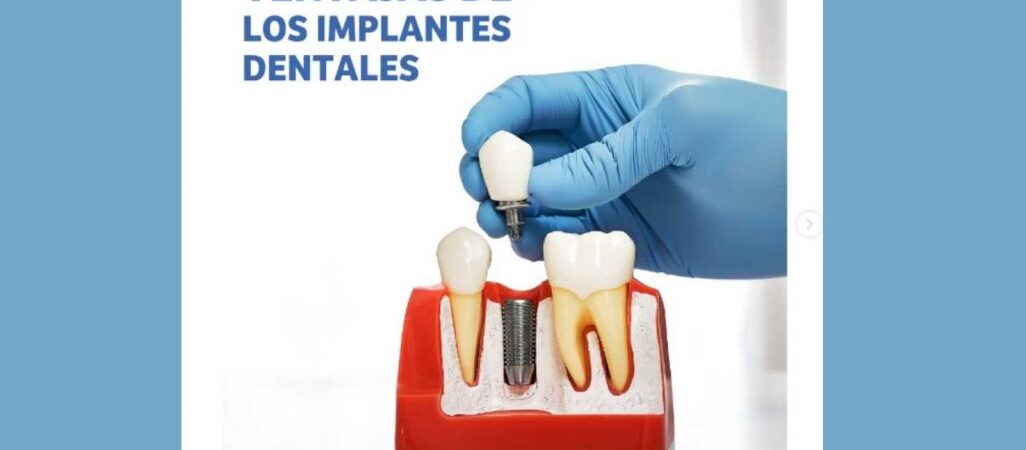 6 beneficios de los implantes dentales mejora tu sonrisa y salud bucal